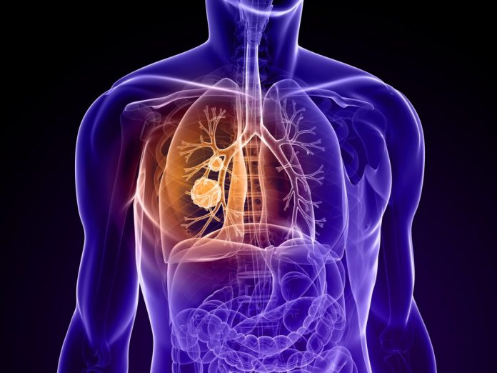Lung cancer death rates may overtake breast cancer