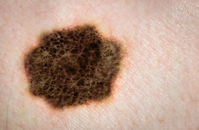 Raising awareness of skin cancer