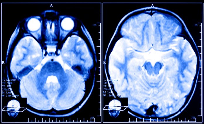 traumatic brain injury