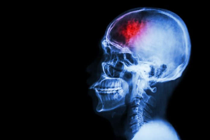 Stroke neuroplasticity X-ray illustration