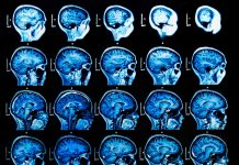 heat shock proteins mri neurodegenerative disease