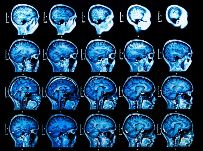 heat shock proteins mri neurodegenerative disease