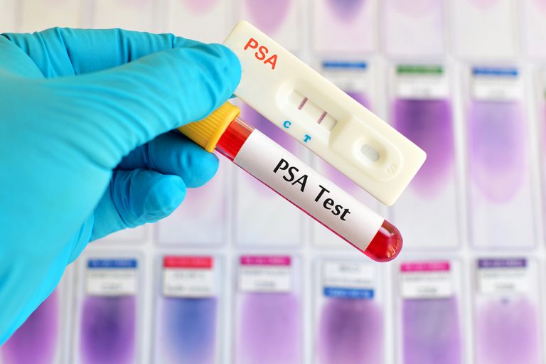 treatments for prostate cancer psa test