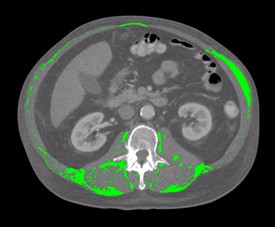 CT image cancer patient