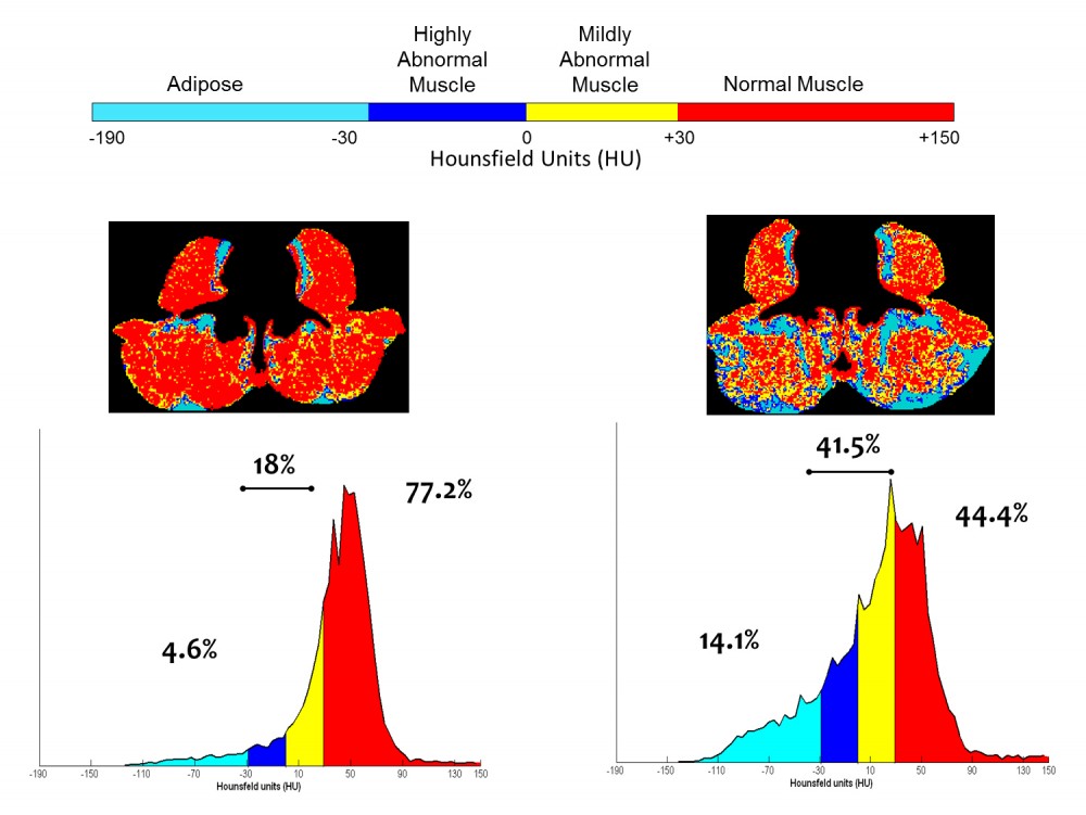 CT images radiation attenuation myosteatosis