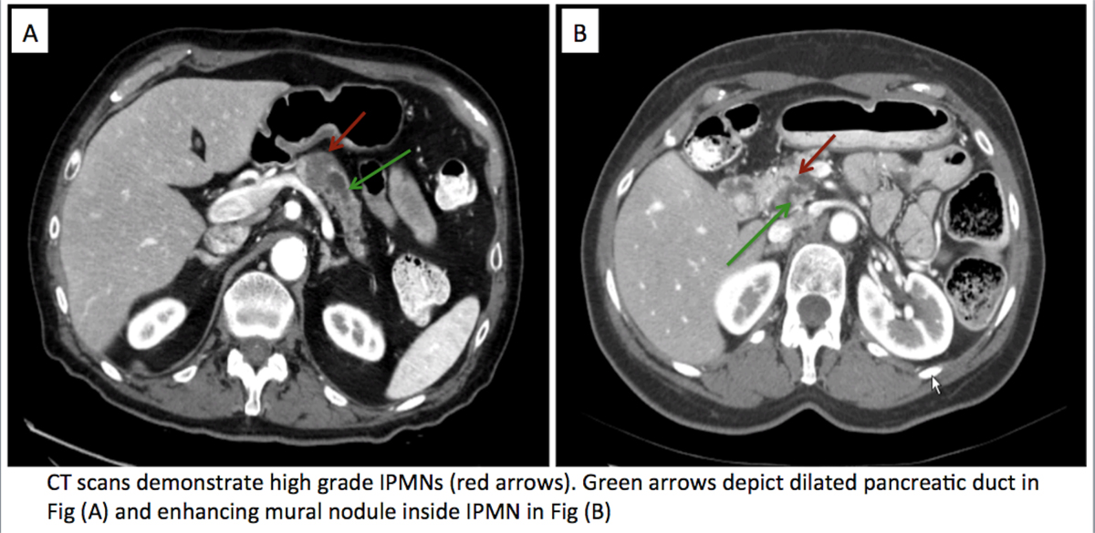 Figure 2: CT scans demonstrate high grade IPMNs (red arrows). Green arrows depict dilated pancreatic duct in (Fig A) and enhancing mural nodule inside IPMN in (Fig B)