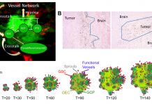 glioblastoma