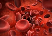 aplastic anaemia