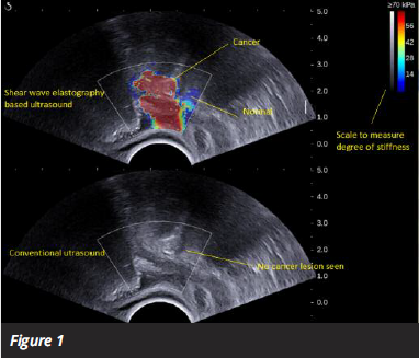 prostate cancer