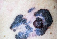 melanoma