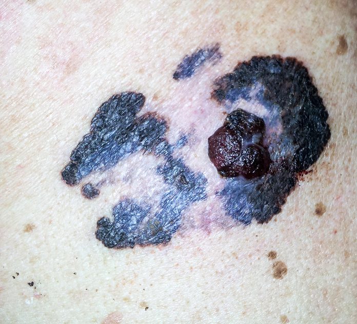 melanoma