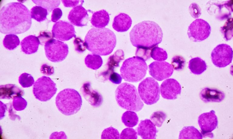 acute myeloid leukaemia