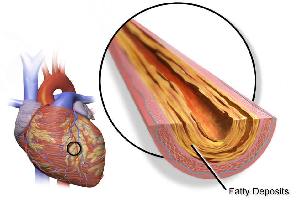 ischemic heart disease