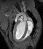Magnetic Resonance of a heart