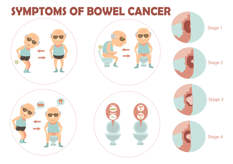 bowel cancer