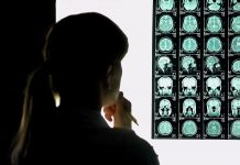 Alzheimer's brain, Alzheimer's disease research