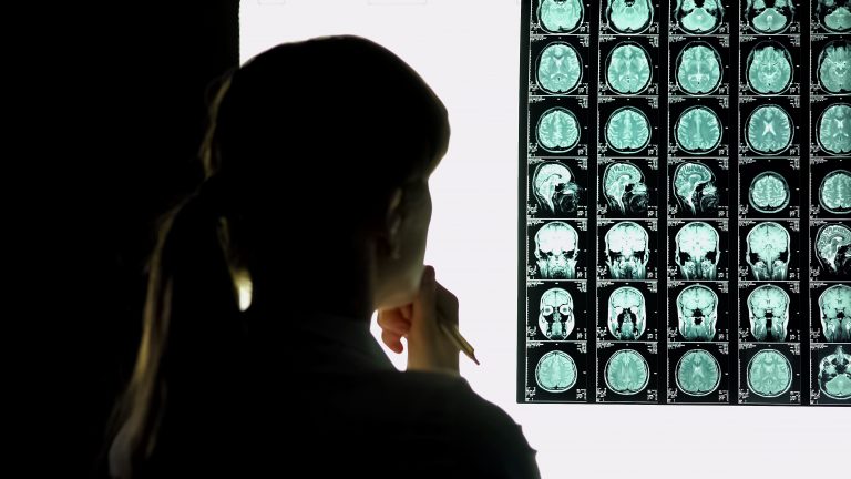Alzheimer's brain, Alzheimer's disease research