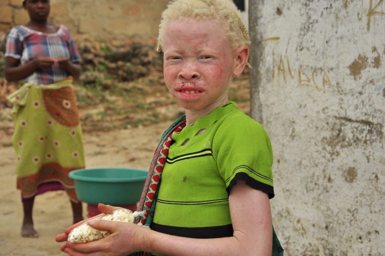 albinos in malawi, malawi's elections