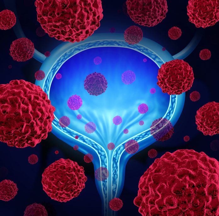 urine DNA test, urothelial cancer