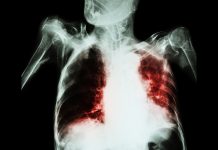 tuberculosis (TB) mortality, Mortality from TB