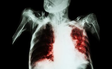 tuberculosis (TB) mortality, Mortality from TB