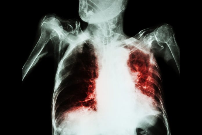 tuberculosis (TB) mortality, Mortality from TB