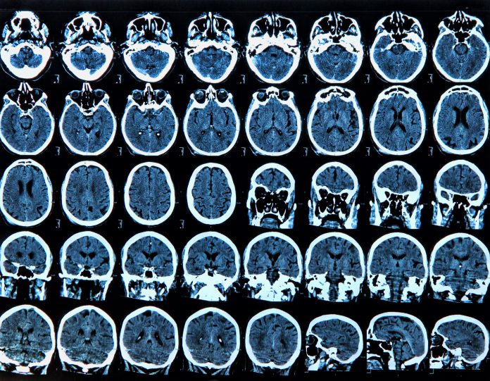 brainwaves to treat pain, chronic pain condition