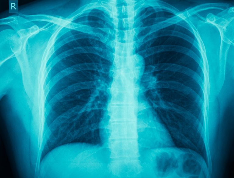 inflammatory lung diseases