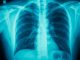 inflammatory lung diseases