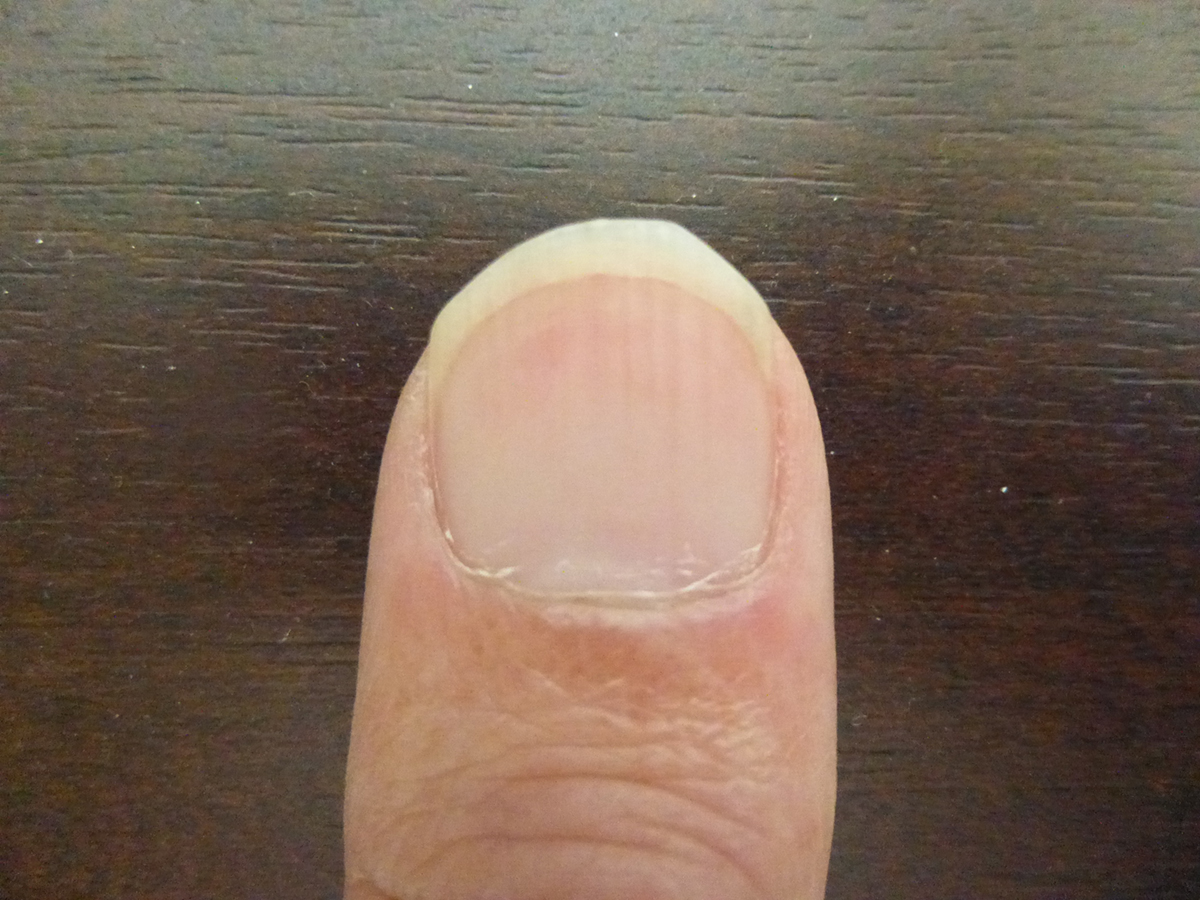 COVID Nails: Pictures, Types, Prognosis