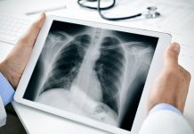 idiopathic pulmonary fibrosis