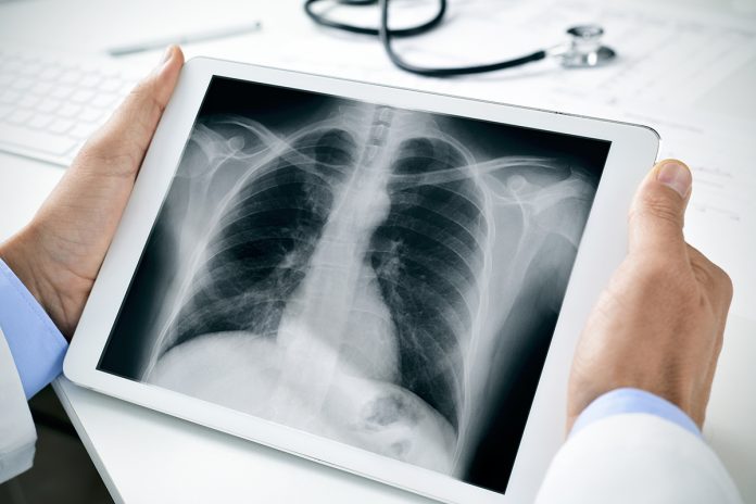 idiopathic pulmonary fibrosis