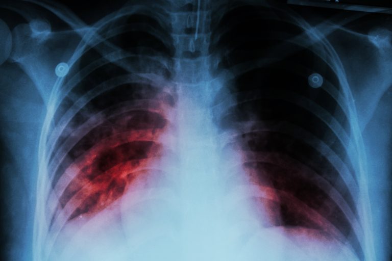 incurable lung disease,idiopathic pulmonary fibrosis