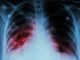 incurable lung disease,idiopathic pulmonary fibrosis