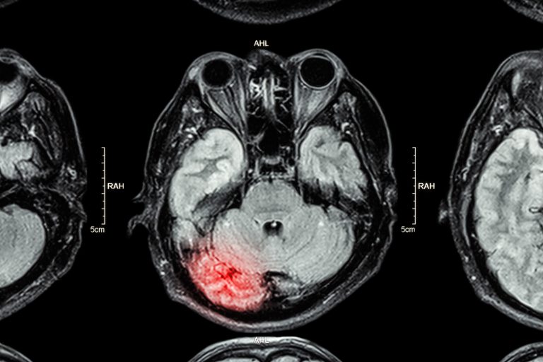 acquired brain injury care, neurorehabilitation