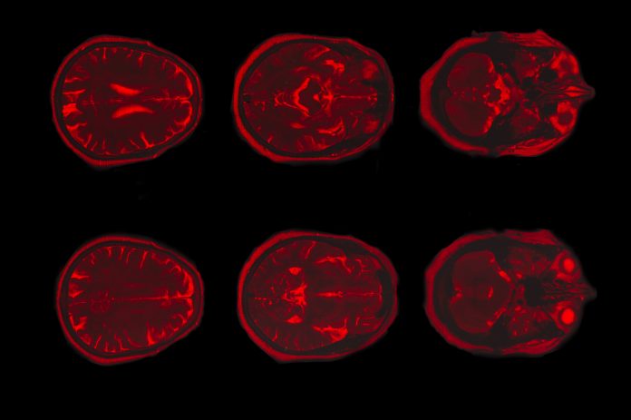 reasons behind depression, amygdala