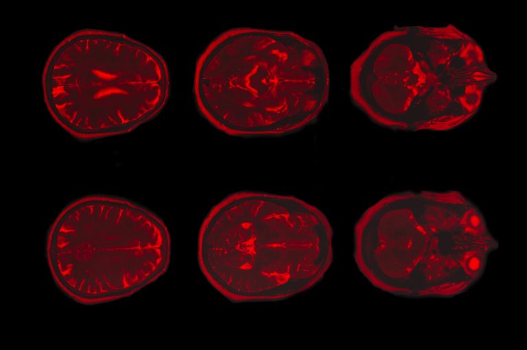 reasons behind depression, amygdala