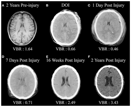 Evaluating and treating mild traumatic brain injury