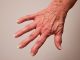 Psoriasis and Rheumatoid Arthritis, cannabinoids