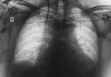 idiopathic pulmonary fibrosis