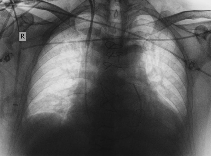 idiopathic pulmonary fibrosis