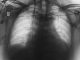 idiopathic pulmonary fibrosis