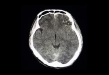 breakthrough in stroke treatment, invasive surgery