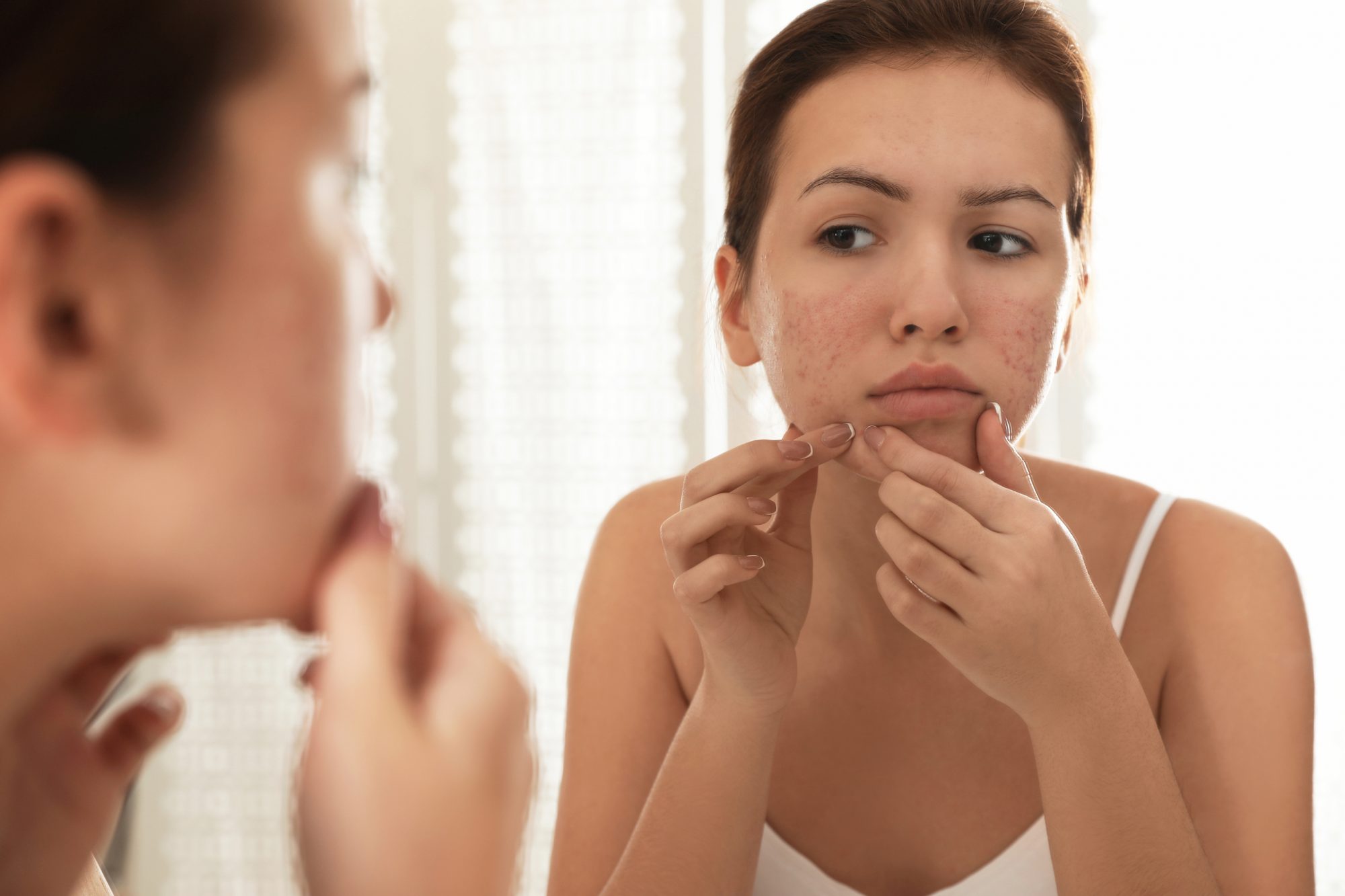 How to manage acne rosacea in times of stress