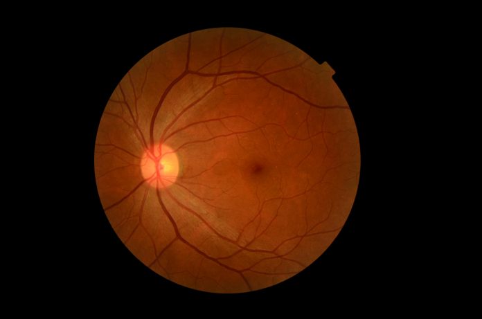 diabetic retinal screening