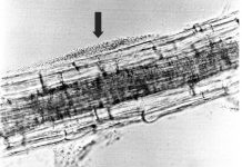 Diarrheal disease