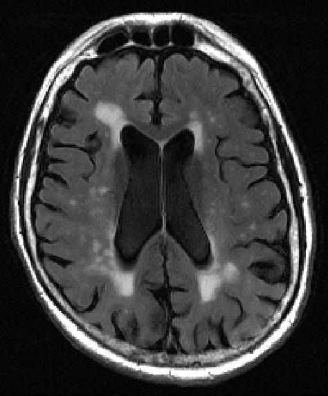 early signs of dementia, mapping