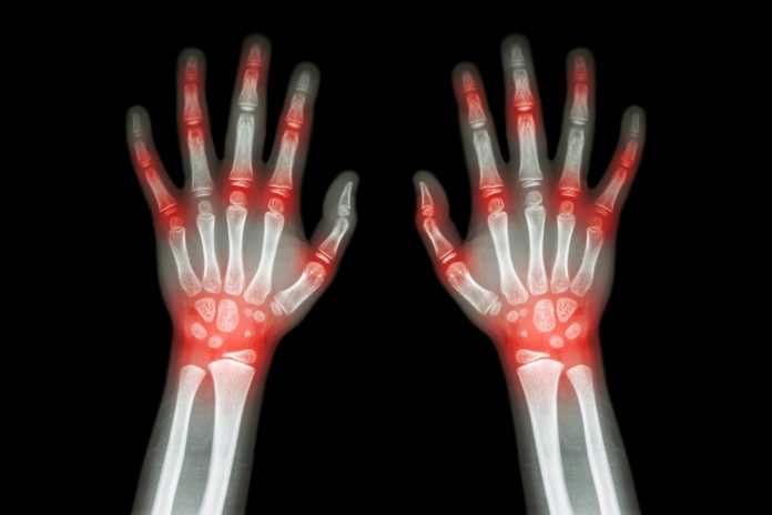 rheumatoid arthritis treatment