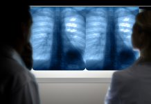 lung cancer diagnosis