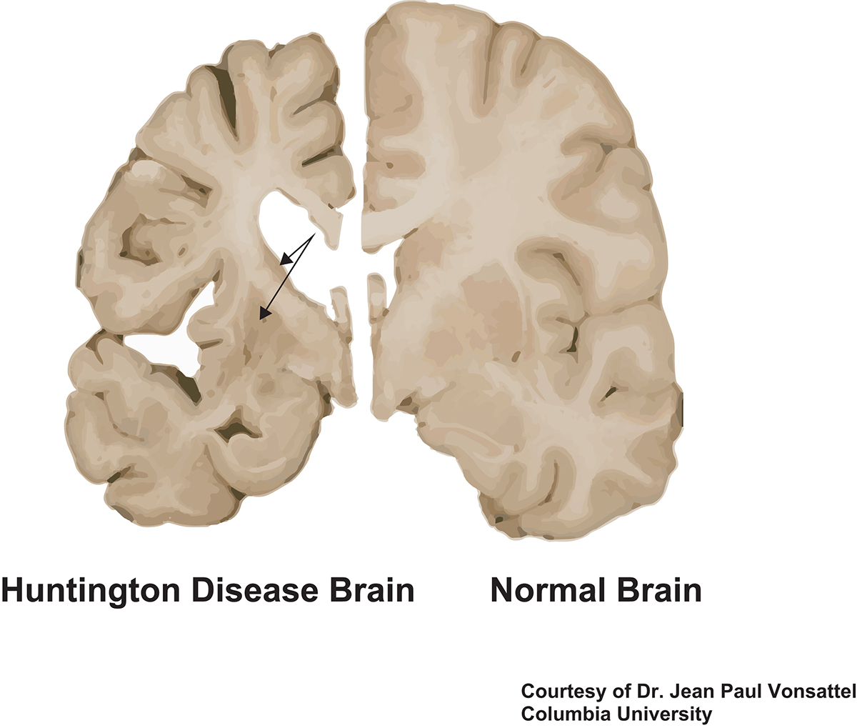 huntington disease